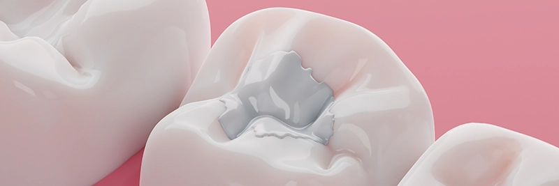 Weiße Kompositfüllungen für Zähne, Behandlungskonzept für Karies und abgebrochene Zähne. 3D-Rendering.